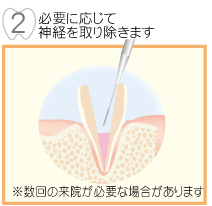 �K�v�ɉ����Đ_�o����菜���܂�
