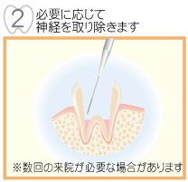 �K�v�ɉ����Đ_�o����菜���܂�