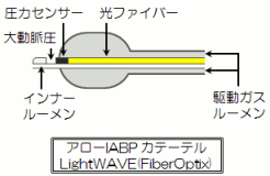 �Z���T�[�t��IABP�J�e�[�e��