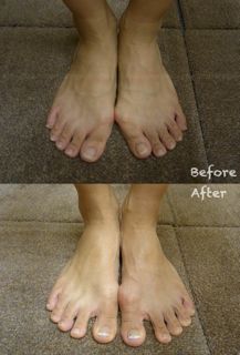 外反母趾施術例.jpg