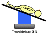 Trenndelenburg̈