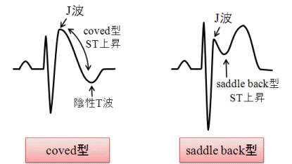 BrugadaǌQ(coved^saddle back^)