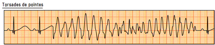 Torsades de pointes(gT[hEhE|gGTdP)