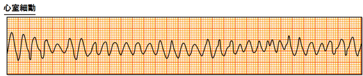 Sד(Ventricular Fibrillation;Vf)