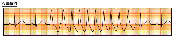 心室頻拍(Ventricular Tachycardia;VT)