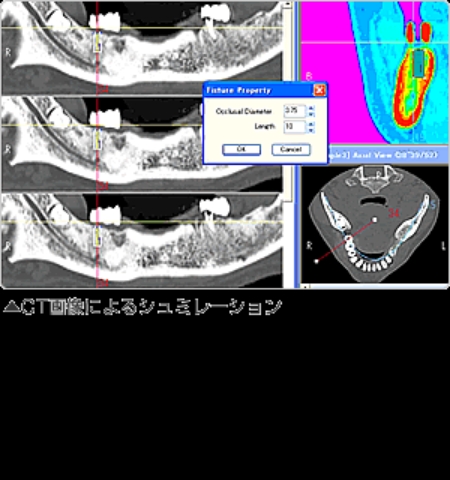 インプラント治療画像