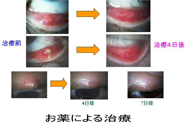 めばちこ ものもらいの治療 ある奈良県の眼科医が目について書いたブログ