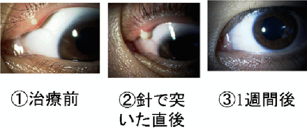 ある奈良県の眼科医が目について書いたブログ 14年01月19日