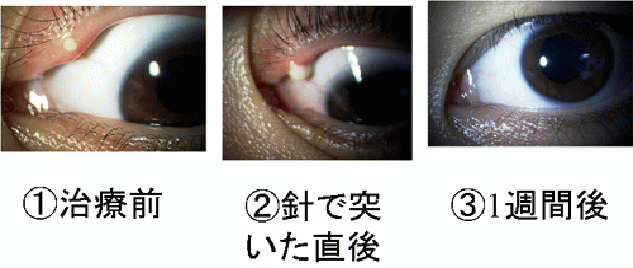 アイプチ 霰粒腫 ものもらいの治し方：早く治すにはどうする？