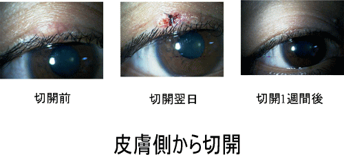 めばちこ ものもらいの治療 ある奈良県の眼科医が目について書いたブログ