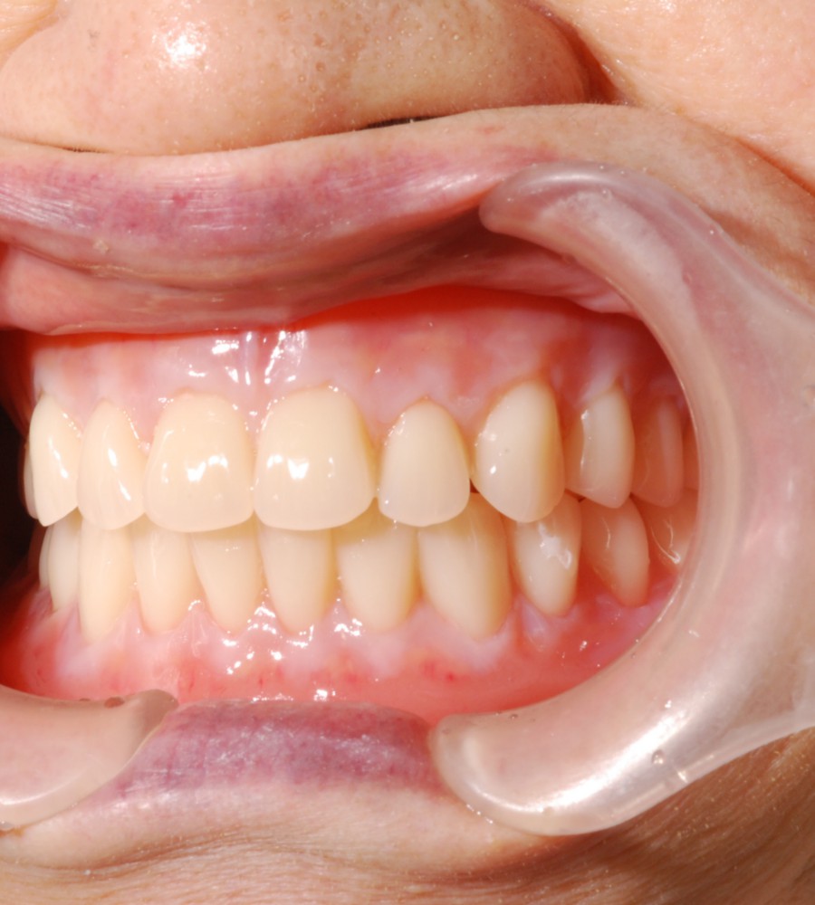 BPS総義歯 （歯肉キャラクタライズオプション）