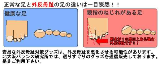 健康な足と外反母趾の違い