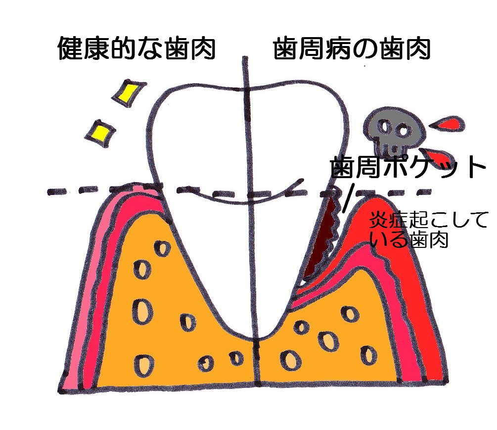 歯周病
