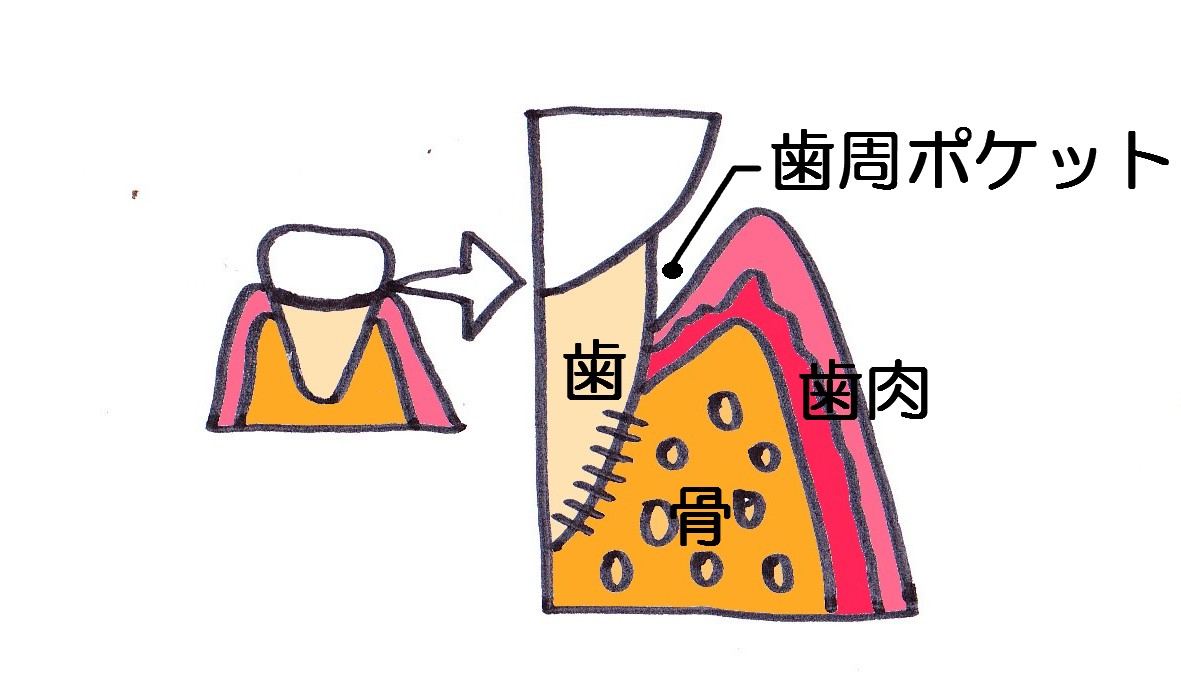 歯周ポケット