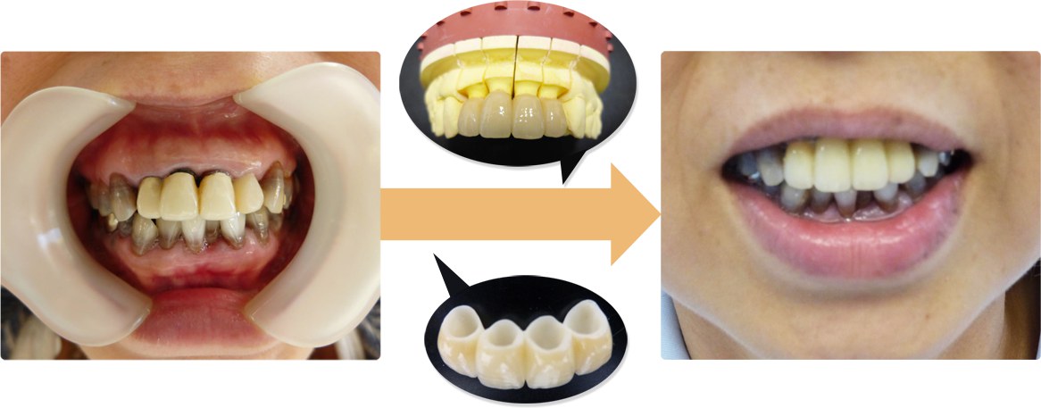 ジルコニアによる治療例
