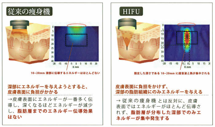 高密度集点式超音波の説明