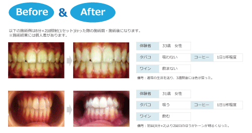歯の変化