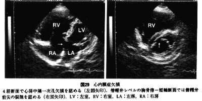 心内膜炎の危険因子は何ですか?
