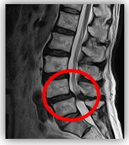 脊柱管狭窄症レントゲン｜BE SEITAI　817パシフィカ堺