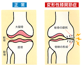 変形性膝関節症｜BE SEITAI　817パシフィカ堺