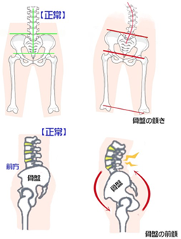 【トピックス・ぎっくり腰】 | 与圧陰陽整体・カイロプラクティックサロン　817パシフィカ堺