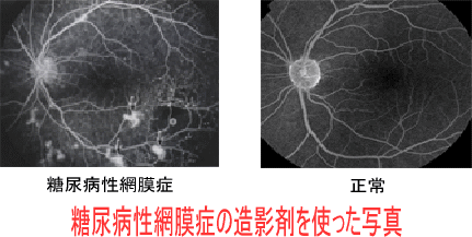糖尿病網膜症に対してレーザー治療ではなく注射が必要なのはなぜですか?